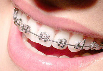 表側（ワイヤー）矯正