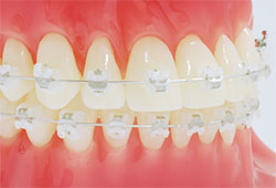 見えない矯正装置