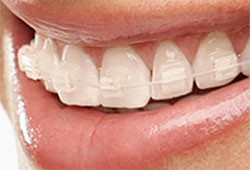 見えない白いワイヤー矯正