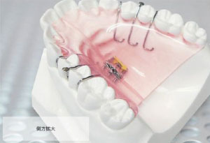 ベストな矯正装置をご提案