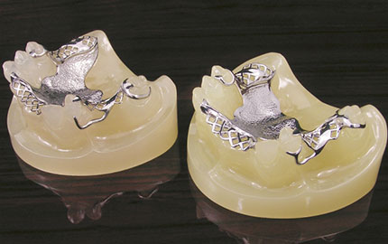金属床の入れ歯