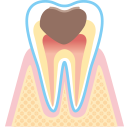 虫歯の進行C3