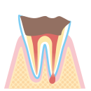 虫歯の進行C4