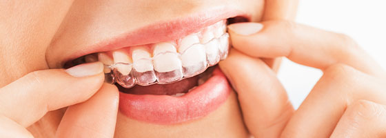 インビザライン