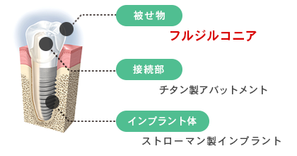 インプラント通常プラン