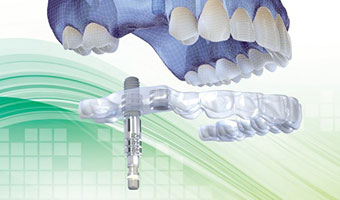 インプラント埋入ガイド