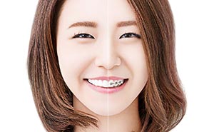 マウスピース矯正は透明で目立たない